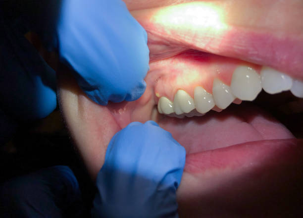 Best Emergency Dentist for Knocked-Out Tooth in Swepsonville, NC